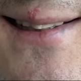 Герпес Стаса Ярушина