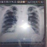 Консультация пульмонологов и фтизиатров