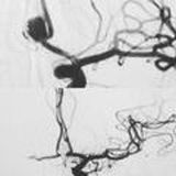 Endovascular Neurosurgery