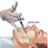 Мандибулярка💉
