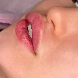 Косметолог • Увеличение губ • ilove_lips