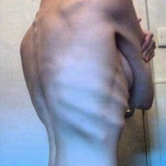 Anorexia